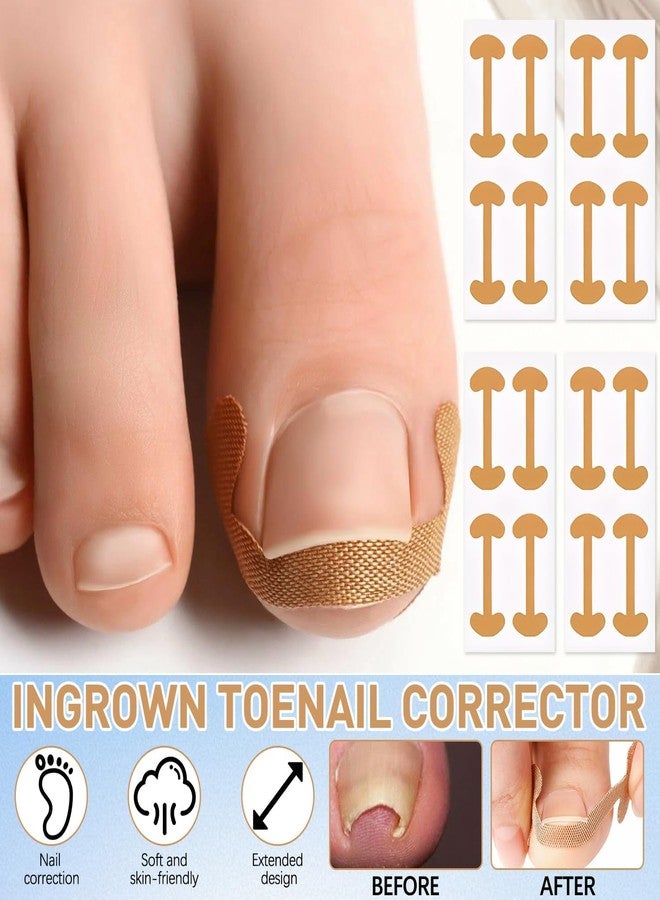 IMOLL Ingrown Toenail Corrector Set with Correction Strips,Professional Ingrown Toenails Pedicure Tool Set, Toenail Correction Strips & Ingrown Toenail Corrector,Ingrown Nail Tool for Women Man - Image 4